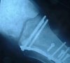 fractura tibia.jpg
